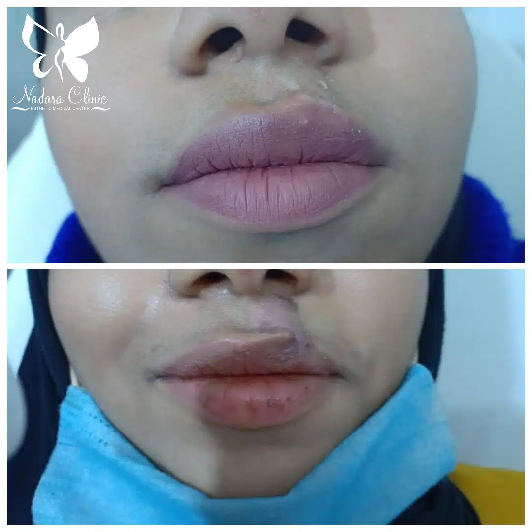 ازالة اثار الحوادث و الجروح بالليزر بالغردقة